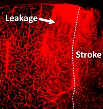 Blood brain barrier leakage after stroke